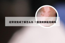 经常挠变成了癣怎么办 一直挠皮肤能出癣吗