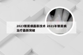 2023银屑病最新技术 2021年银屑病治疗最新突破