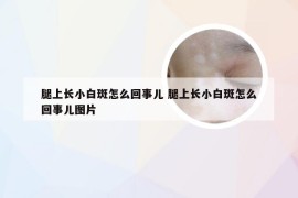 腿上长小白斑怎么回事儿 腿上长小白斑怎么回事儿图片