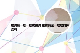 银屑病一层一层脱鳞屑 银屑病是一层层的掉皮吗