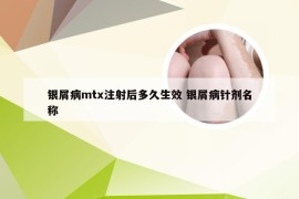 银屑病mtx注射后多久生效 银屑病针剂名称