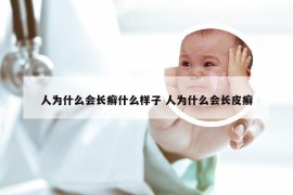 人为什么会长癣什么样子 人为什么会长皮癣