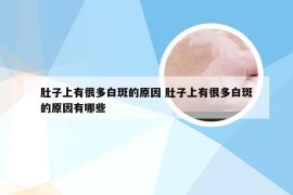 肚子上有很多白斑的原因 肚子上有很多白斑的原因有哪些