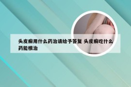 头皮癣用什么药治请给予答复 头皮癣吃什么药能根治