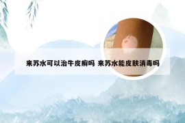 来苏水可以治牛皮癣吗 来苏水能皮肤消毒吗