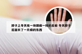 脖子上冬天有一块跟癣一样的皮癣 冬天脖子后面长了一片癣的东西