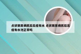 点状银屑病抓后出痘有水 点状银屑病抓后出痘有水泡正常吗