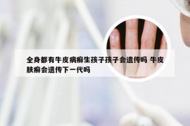 全身都有牛皮病癣生孩子孩子会遗传吗 牛皮肤癣会遗传下一代吗