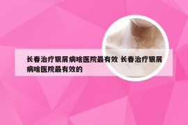 长春治疗银屑病啥医院最有效 长春治疗银屑病啥医院最有效的