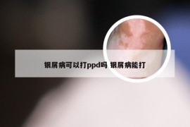 银屑病可以打ppd吗 银屑病能打