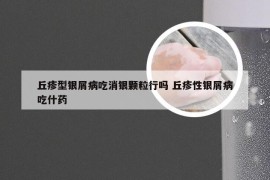 丘疹型银屑病吃消银颗粒行吗 丘疹性银屑病吃什药