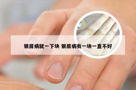 银屑病就一下块 银屑病有一块一直不好