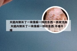 大腿内侧长了一块像癣一样的东西一抓就流血 大腿内侧长了一块像癣一样的东西 不痛不痒