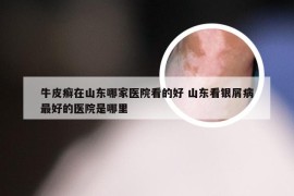 牛皮癣在山东哪家医院看的好 山东看银屑病最好的医院是哪里