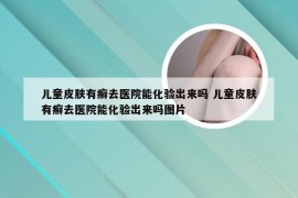 儿童皮肤有癣去医院能化验出来吗 儿童皮肤有癣去医院能化验出来吗图片