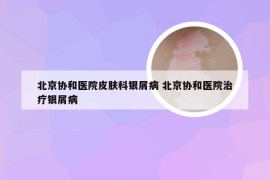 北京协和医院皮肤科银屑病 北京协和医院治疗银屑病