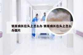 银屑病长在头上怎么办 银屑病长在头上怎么办图片