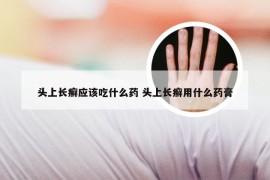 头上长癣应该吃什么药 头上长癣用什么药膏