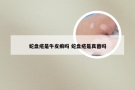 蛇盘疮是牛皮癣吗 蛇盘疮是真菌吗