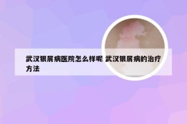 武汉银屑病医院怎么样呢 武汉银屑病的治疗方法