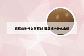 银屑病泡什么茶可以 银屑病泡什么水喝