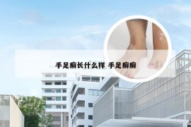 手足癣长什么样 手足癣癣