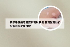 孩子牛皮癣吃甘露聚糖肽胶囊 甘露聚糖肽口服液治疗皮肤过敏