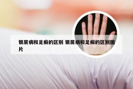 银屑病和足癣的区别 银屑病和足癣的区别图片