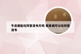 牛皮癣能吃阿昔洛韦片吗 银屑病可以吃阿昔洛韦