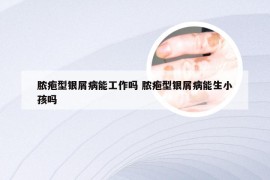 脓疱型银屑病能工作吗 脓疱型银屑病能生小孩吗