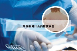 牛皮癣用什么药比较安全