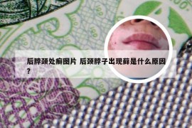 后脖颈处癣图片 后颈脖子出现藓是什么原因?