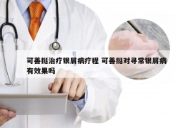 可善挺治疗银屑病疗程 可善挺对寻常银屑病有效果吗