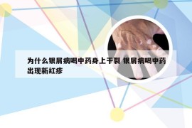 为什么银屑病喝中药身上干裂 银屑病喝中药出现新红疹