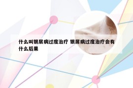 什么叫银屑病过度治疗 银屑病过度治疗会有什么后果