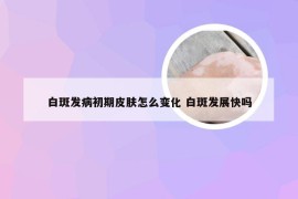 白斑发病初期皮肤怎么变化 白斑发展快吗