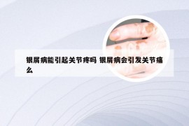 银屑病能引起关节疼吗 银屑病会引发关节痛么