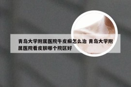 青岛大学附属医院牛皮癣怎么治 青岛大学附属医院看皮肤哪个院区好