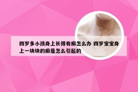 四岁多小孩身上长得有癣怎么办 四岁宝宝身上一块块的癣是怎么引起的