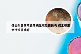 保定附属医院银屑病注院能报销吗 保定哪里治疗银屑病好