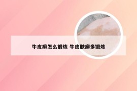 牛皮癣怎么锻炼 牛皮肤癣多锻炼