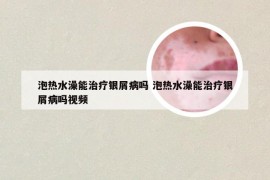 泡热水澡能治疗银屑病吗 泡热水澡能治疗银屑病吗视频