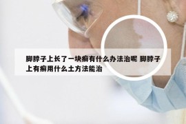 脚脖子上长了一块癣有什么办法治呢 脚脖子上有癣用什么土方法能治