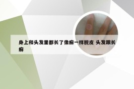 身上和头发里都长了像癣一样脱皮 头发跟长癣