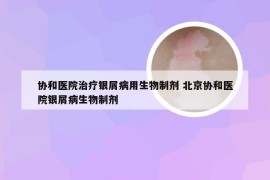 协和医院治疗银屑病用生物制剂 北京协和医院银屑病生物制剂