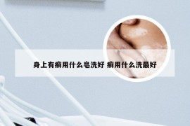 身上有癣用什么皂洗好 癣用什么洗最好