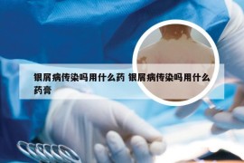 银屑病传染吗用什么药 银屑病传染吗用什么药膏