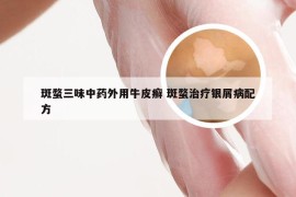 斑蝥三味中药外用牛皮癣 斑蝥治疗银屑病配方