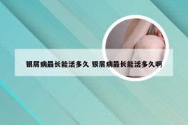 银屑病最长能活多久 银屑病最长能活多久啊