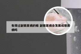 有得过副银屑病的嘛 副银屑病会发展成银屑病吗